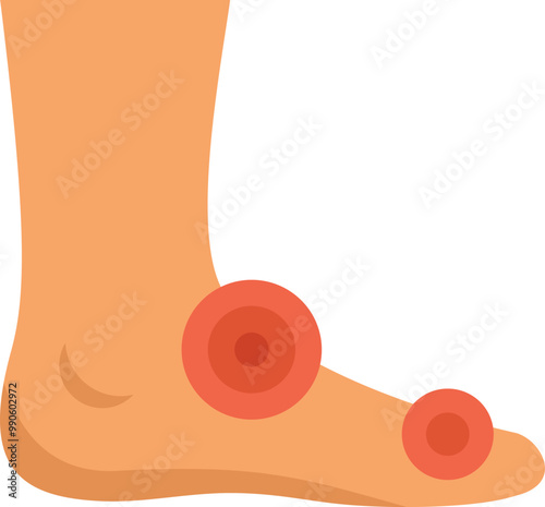 Human foot with hallux valgus symptom, showing inflamed big toe joint