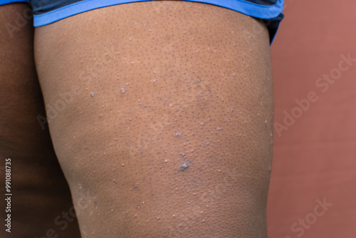 Eczema on brown skin, atopic dermatitis and prurigo nodularis on brown skin leg, eczema breakout on dark skin photo