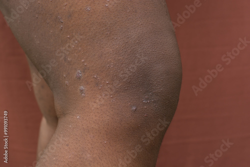 Eczema on brown skin, atopic dermatitis and prurigo nodularis on brown skin leg, eczema breakout on dark skin photo