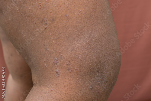 Eczema on brown skin, atopic dermatitis and prurigo nodularis on brown skin leg, eczema breakout on dark skin photo