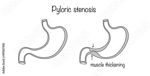 Pyloric stenosis