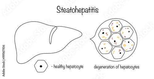 Steatohepatitis