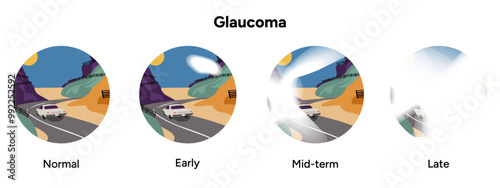 Healthy eye and eye with glaucoma. Inflammatory glaucoma. Neovascular glaucoma. Traumatic glaucoma