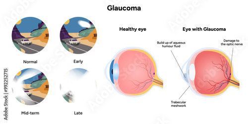 Healthy eye and eye with glaucoma. Eye anatomy. Early, mid-term and late glaucoma
