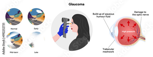 Ophthalmology eye testing. Pneumotonometer. Eye glaucoma anatomy. Early, mid-term and late glaucoma
