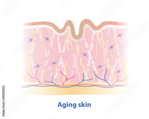 Broken collagen, elastin fibers and reduced fibroblasts size with aging skin layer vector illustration isolated on white background. Formation of wrinkled skin, lose strength, flexibility, firmness.