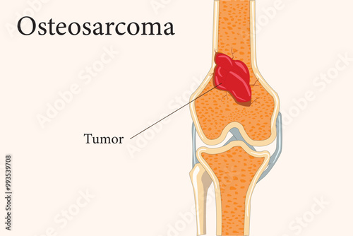 Split bone revealing an osteosarcoma tumor inside, highlighting malignant growth and bone pathology. cross section. eps 10