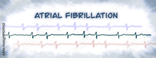 ECG example of atrial fibrillation