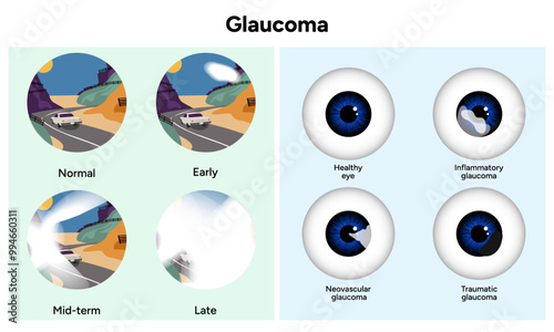 Healthy eye and eye with glaucoma. Inflammatory glaucoma. Neovascular glaucoma. Traumatic glaucoma. Early, mid-term and late glaucoma