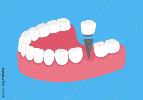 Tooth implant screw in gum flat design vector illustration.