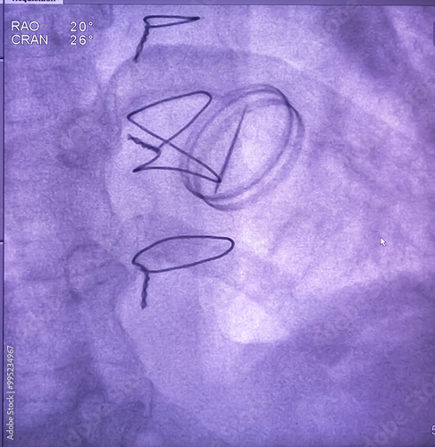 X ray image of heart valve. severe nefriction of mechanical mitral prosthetic valve. photo