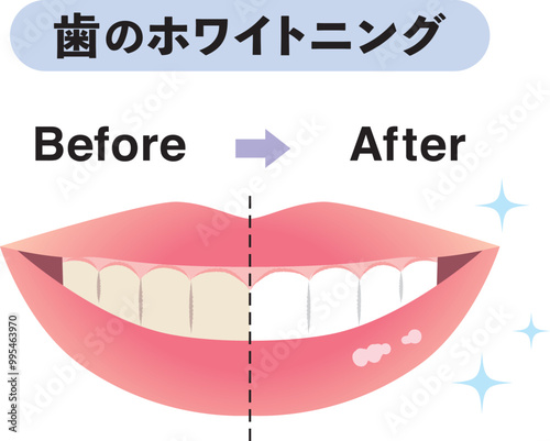 歯のホワイトニング
