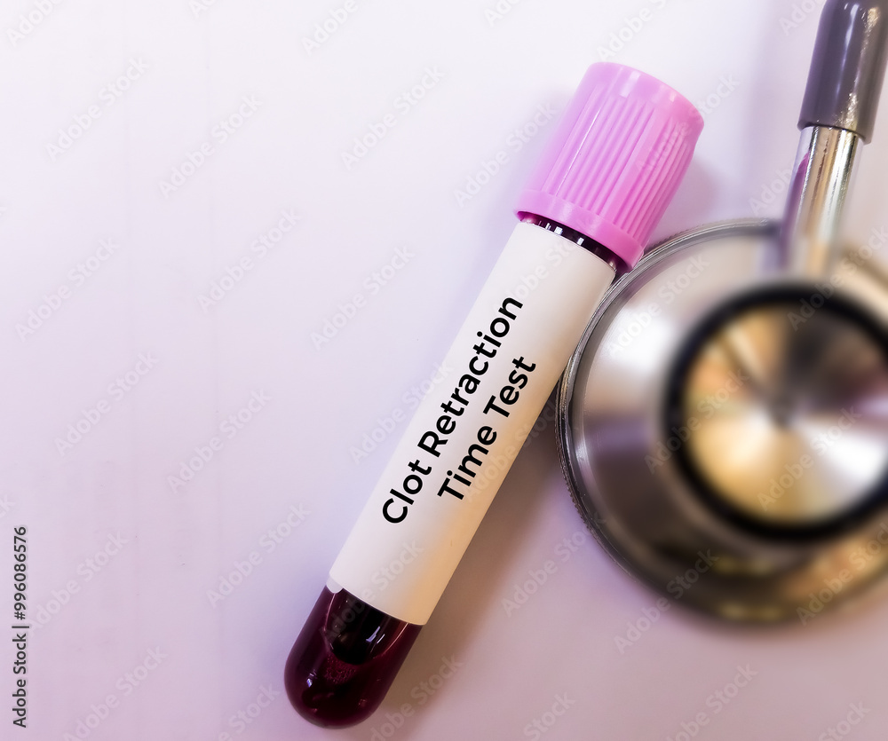 Blood sample for clot retraction test, to measures the time taken for a ...