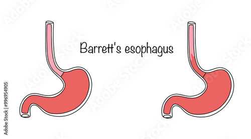 Barrett's esophagus