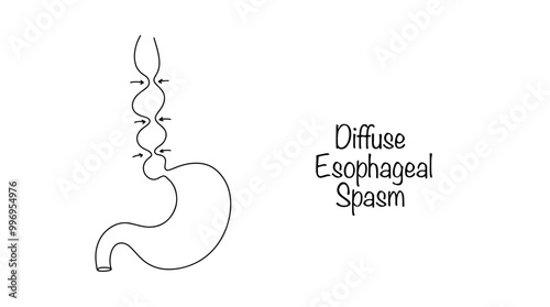 Diffuse Esophageal Spasm photo