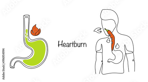 Heartburn