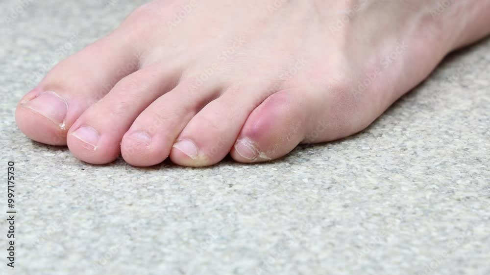 Foot with swollen stubbed pinky toe moving uncomfortably 