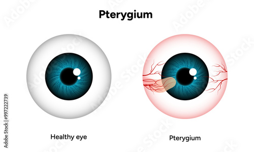 Pterygium eye disease and health eye optometry appointment 