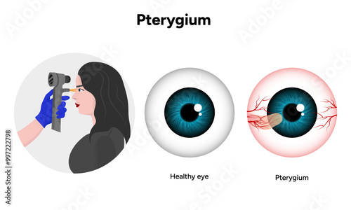 Pterygium eye disease and health eye optometry appointment 