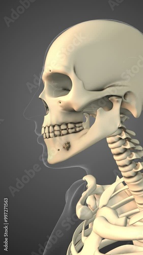 Cancer spreading along a mouth bone