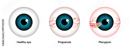 Optometry appointment healthy eye pinguecula and pterygium