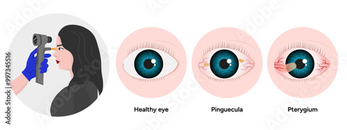 Optometry appointment healthy eye pinguecula and pterygium