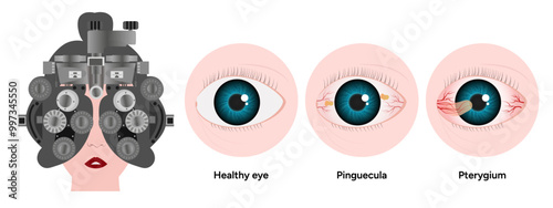 Optometry appointment healthy eye pinguecula and pterygium