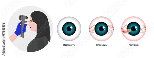 Optometry appointment healthy eye pinguecula and pterygium