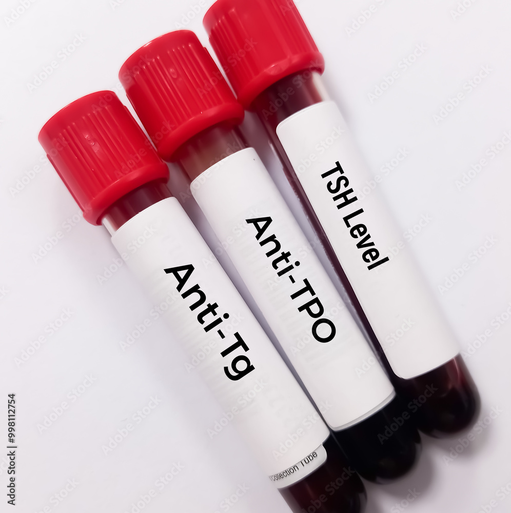 Blood sample for thyroid peroxidase antibodies or anti tpo test and