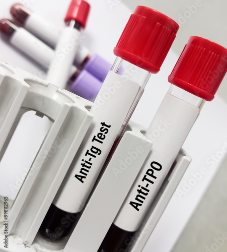 Blood sample for Thyroid Peroxidase Antibodies or Anti-TPO test and anti-Tg Test. Thyroid function tests, to diagnosis of hypothyroidism and thyroiditis. photo