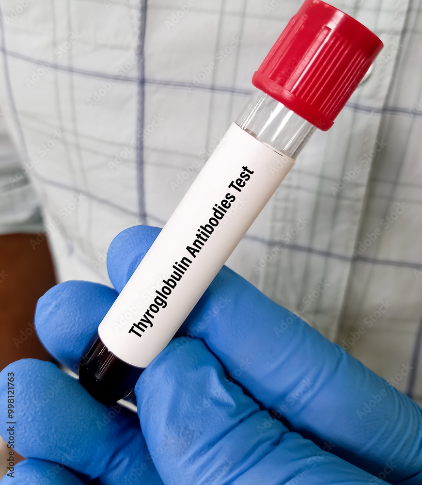 Blood sample for Thyroid Peroxidase Antibodies or Anti-TPO test and anti-Tg Test. Thyroid function tests, to diagnosis of hypothyroidism and thyroiditis. Blood sample for Thyroid Peroxidase Antibodies or Anti-TPO test and anti-Tg Test. Thyroid function tests, to diagnosis of hypothyroidism and thyroiditis.