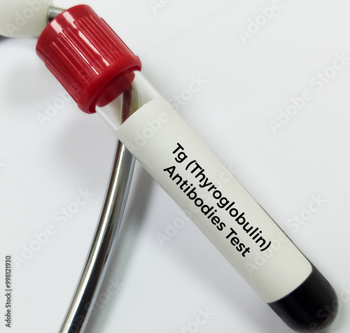 Blood sample for Thyroid Peroxidase Antibodies or Anti-TPO test and anti-Tg Test. Thyroid function tests, to diagnosis of hypothyroidism and thyroiditis. photo