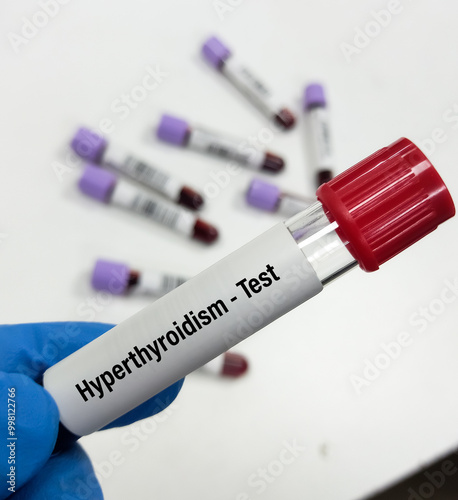 Blood sample for Thyroid Peroxidase Antibodies or Anti-TPO test and anti-Tg Test. Thyroid function tests, to diagnosis of hypothyroidism and thyroiditis. photo