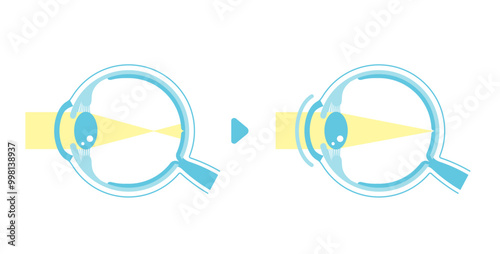 Illustration comparing vision before and after wearing contact lens