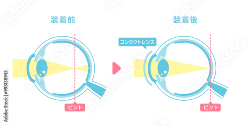 コンタクトレンズ装着時のピント位置 ベクターイラスト