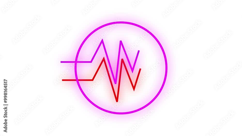 ECG with supraventricular premature beats and short paroxysms of neon atrial fibrillation ECG with supraventricular premature beats and short paroxysms of neon atrial fibrillation
