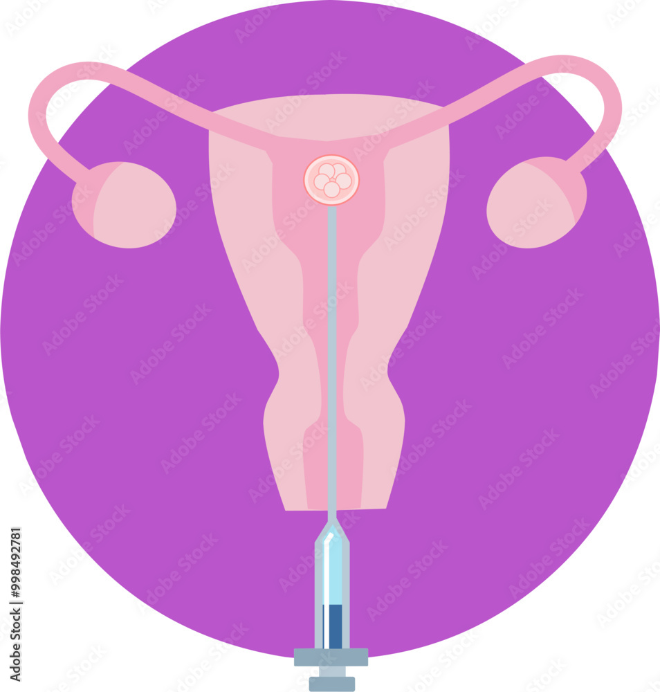 In Vitro fertilization IVF embryo infographic and infertility treatment scheme. Ovarian hyperstimulation, artificial insemination, embryo culture and cryopreservation. Medical procedure for pregnancy In Vitro fertilization IVF embryo infographic and infertility treatment scheme. Ovarian hyperstimulation, artificial insemination, embryo culture and cryopreservation. Medical procedure for pregnancy