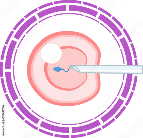 In Vitro fertilization IVF vector infographic and infertility treatment scheme with purple dot line artificial insemination, embryo culture and cryopreservation. Medical procedure for pregnancy