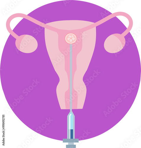 In Vitro fertilization IVF embryo infographic and infertility treatment scheme. Ovarian hyperstimulation, artificial insemination, embryo culture and cryopreservation. Medical procedure for pregnancy