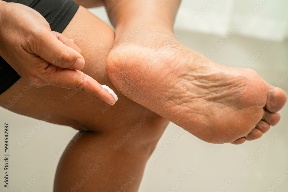Fototapeta premium Asian woman applying moisturizing cream skincare treatment to solve and repair feet with crack and dry heel skin.