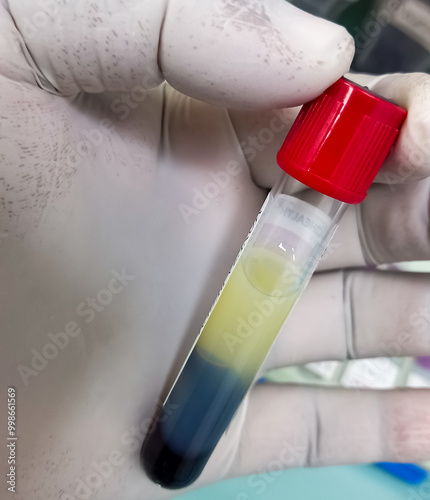 Scientist hold Lipemic blood sample, high Triglyceride contain serum sample. Lipemia photo