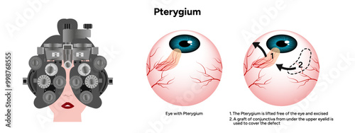 Pterygium eye disease lifted free of the eye and excised optometry appointment 
