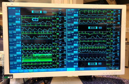 EKG, Pulse, BP and Respiration ICU Monitor Screen photo