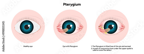 Pterygium eye disease lifted free of the eye and excised optometry appointment 