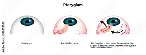 Pterygium eye disease lifted free of the eye and excised optometry appointment 