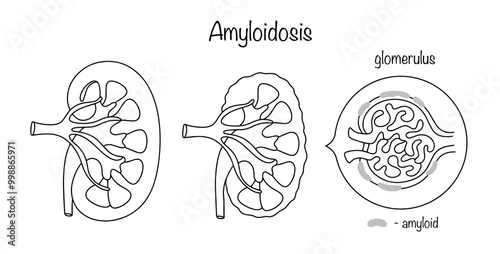 Amyloidosis