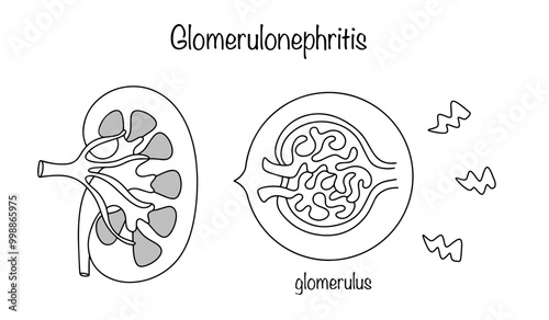 Glomerulonephritis