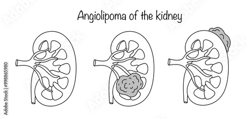 Angiolipoma of the kidney