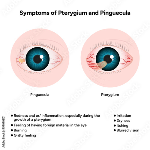 Symptoms of pterygium and pinguecula Optometry disease 