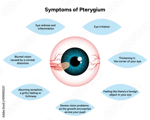 Symptoms of pterygium and pinguecula Optometry disease 